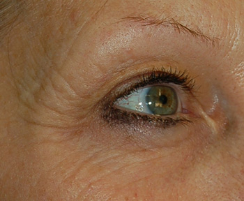 Crow's feet before fractional laser skin resurfacing